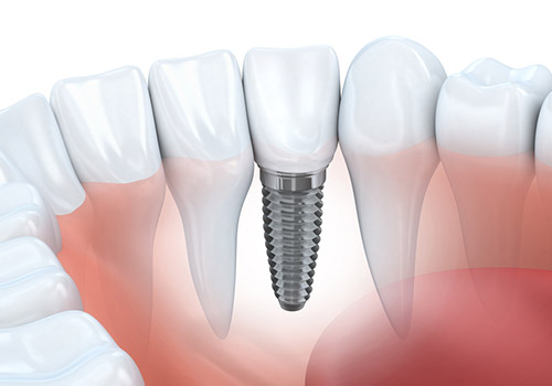 dental implants