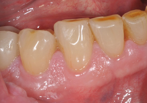 advanced periodontal disease